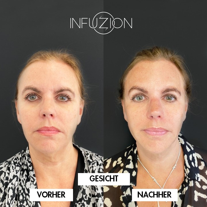 INFUZION® Herstellerbeispiel 3: Gesicht vor und nach der Anwendung