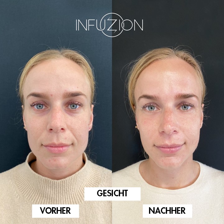 INFUZION® Herstellerbeispiel 2: Gesicht vor und nach der Anwendung